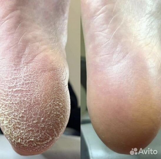 Маникюр.педикюр.Подолог