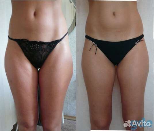 Лимфодренажный массаж