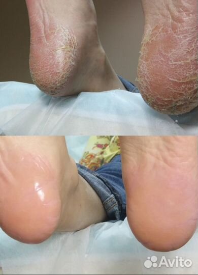 Педикюр(муж./жен),Подология, Смарт-педикюр