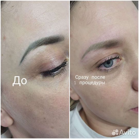 Лазерное удаление татуажа/тату