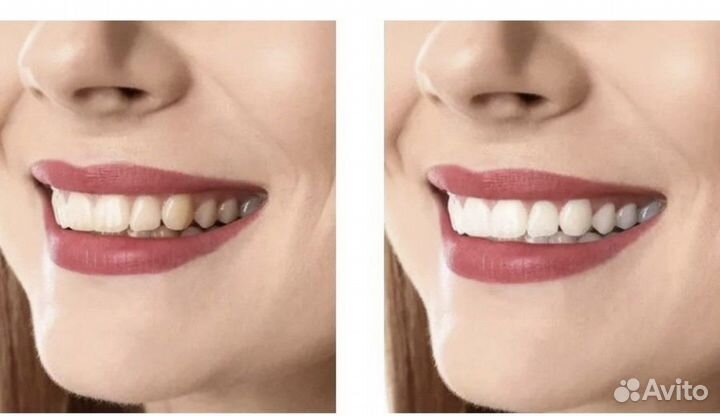 Отбеливающие полоски 5Д