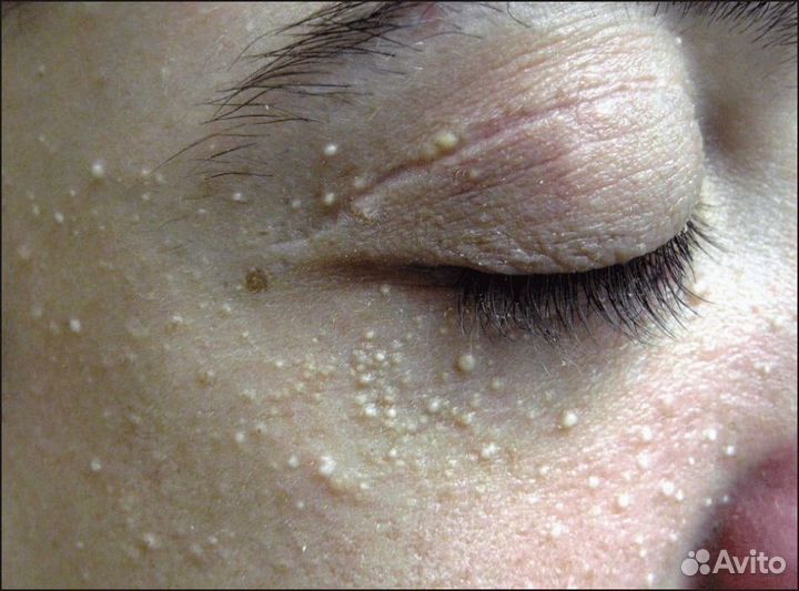 Удаление папиллом, жировиков, бородавок, гемангиом