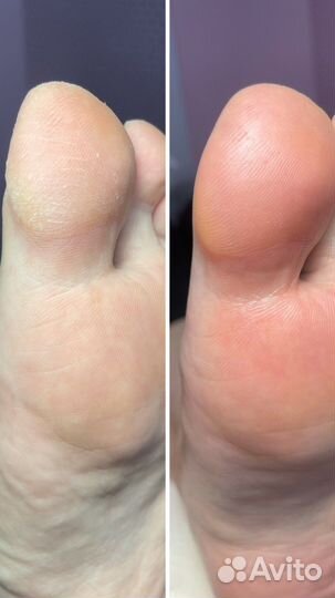 Педикюр на дому