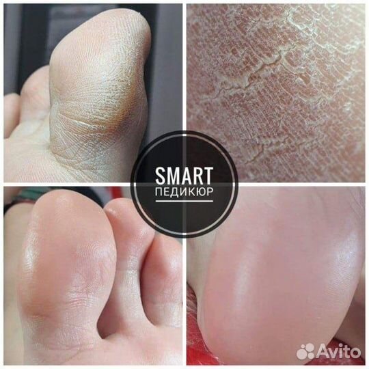 Педикюр(муж./жен),Подология, Смарт-педикюр