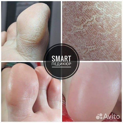 Педикюр(муж./жен),Подология, Смарт-педикюр
