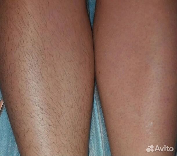 Эпиляция,депиляция: мужчин и женщин