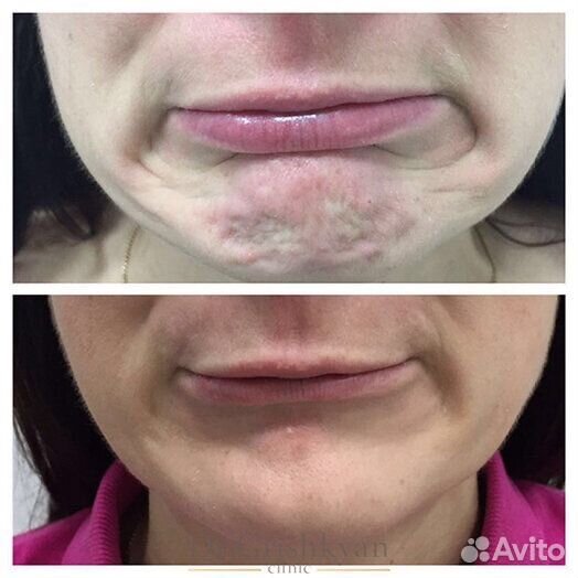 Модель на ботокс лица