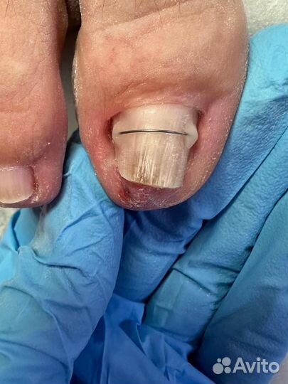 Подолог Педикюр Вросший ноготь Онихолизис