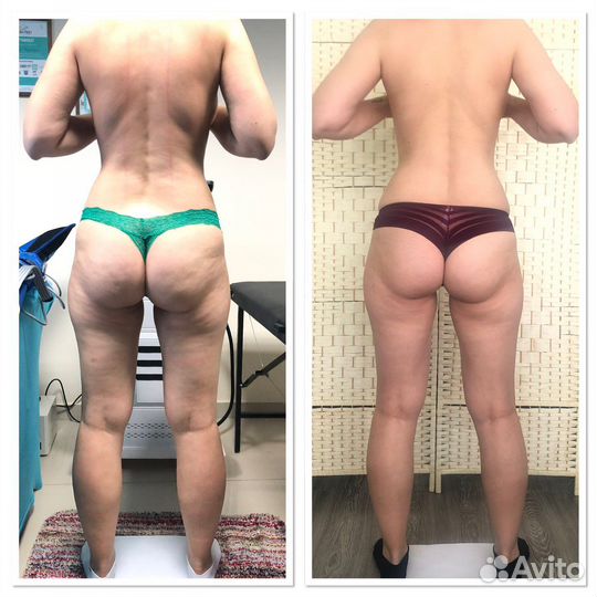 Аппаратная коррекция фигуры