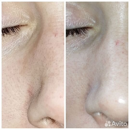 Ультразвуковая чистка лица