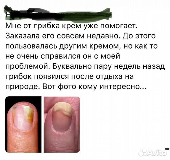 Актилайн - средство убирает грибок кожи и ногтей