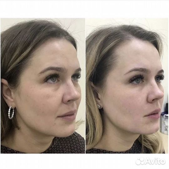 Скульптурный массаж лица + карбокситерапия