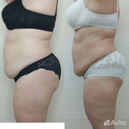 Аппаратный массаж/Коррекция фигуры