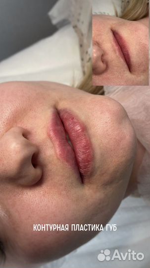 Вкусные губы корекция увеличение пластика губ