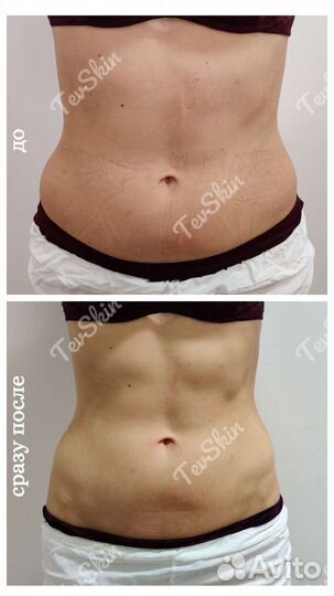 Липосоникс.Коррекция фигуры.Уменьшение объемов