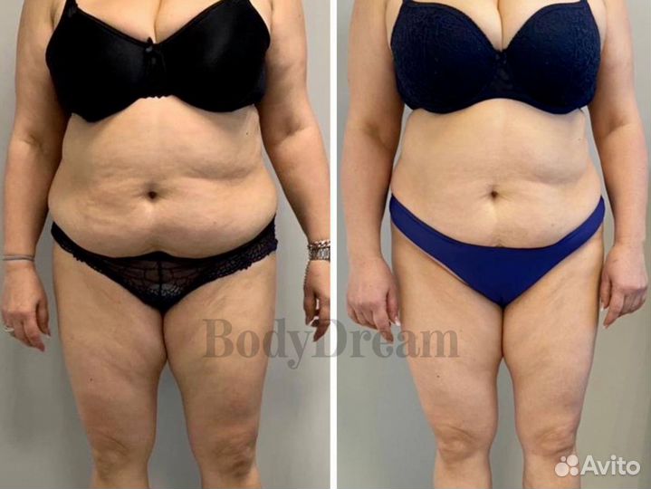 Антицеллюлитный массаж, коррекция фигуры