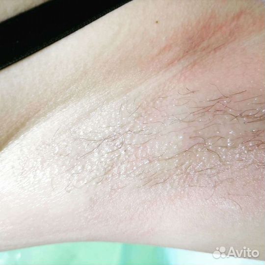 Электроэпиляция