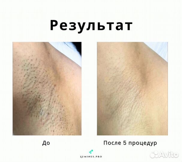 Диодный лазер Lumines Макс’Ван 1200W