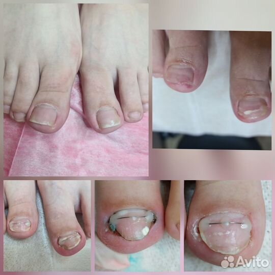 Подолог, вросший ноготь