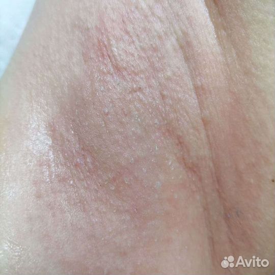 Электроэпиляция