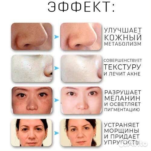 Дарсонваль для волос, лица и тела 4 насадками