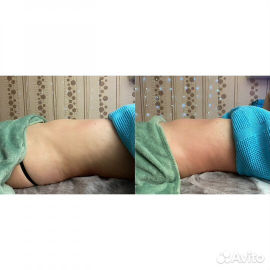 Антицеллюлитный массаж