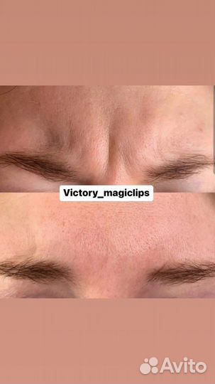 Ботокс для лица