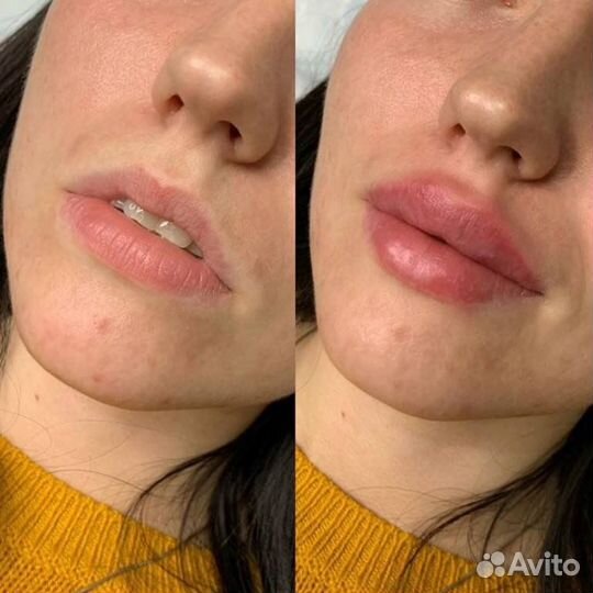 Инъекции ботокса в лоб