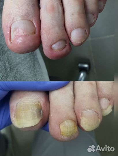 Подолог. Проблемные ногти. Выезд на дом