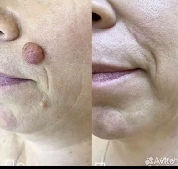 Врач косметолог услуги. Ботокс, филлеры