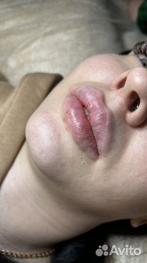 Увеличение губ