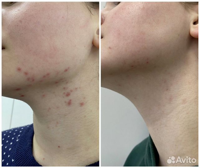 Чистка лица, массаж, дермапен