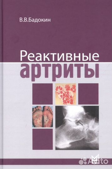 Реактивные артриты