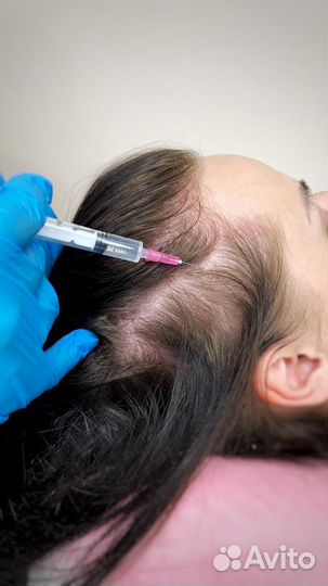 Мезотерапия волос