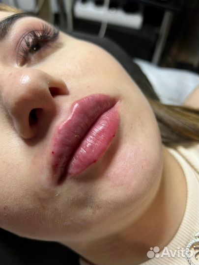 Увеличение губ, ботокс, гипергидроз