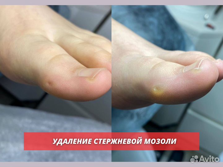 Подолог Лечение грибка Удаление мозолей