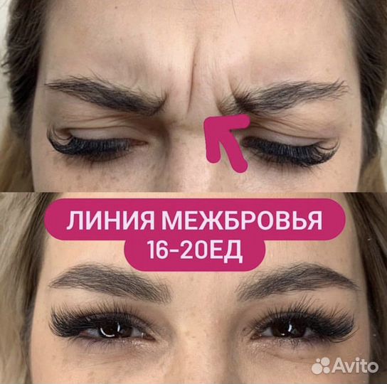 Модель на ботокс