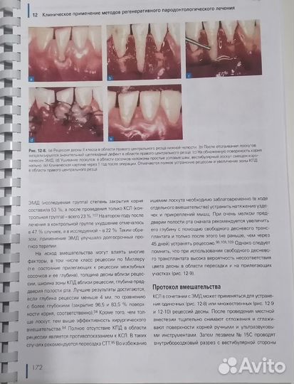 Регенерация пародонта