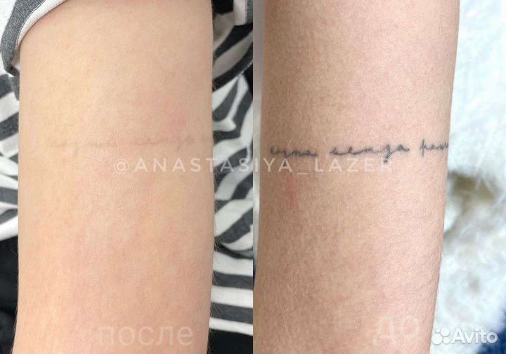 Удаление Тату/Татуажа лазером, карбоновый пилинг