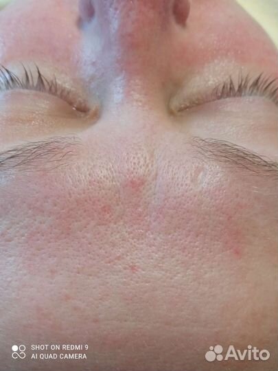 Дарсонвализация