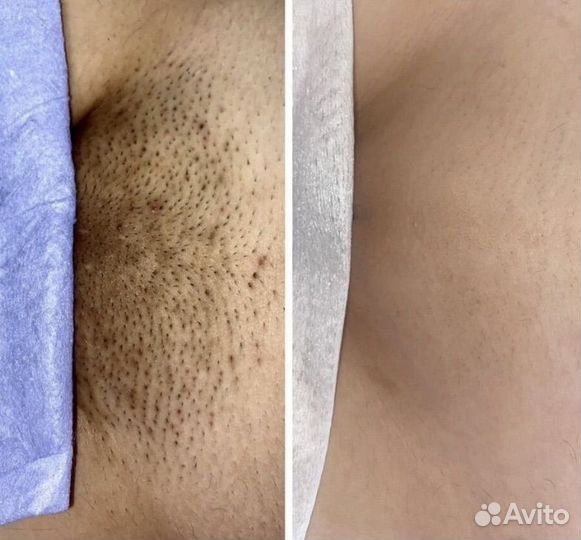 Лазерная эпиляция диодный лазер все тело 3000