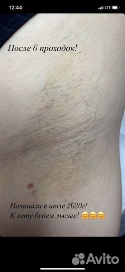 Электроэпиляция