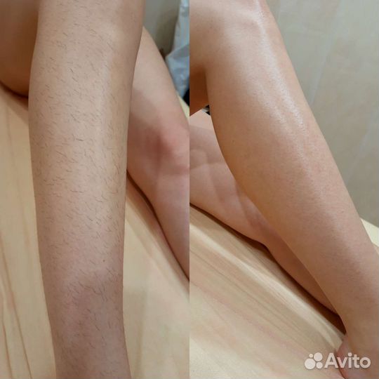 Депиляция