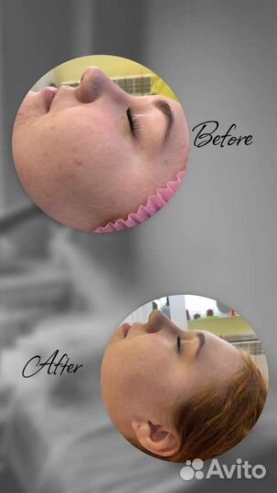 Биоревитализация