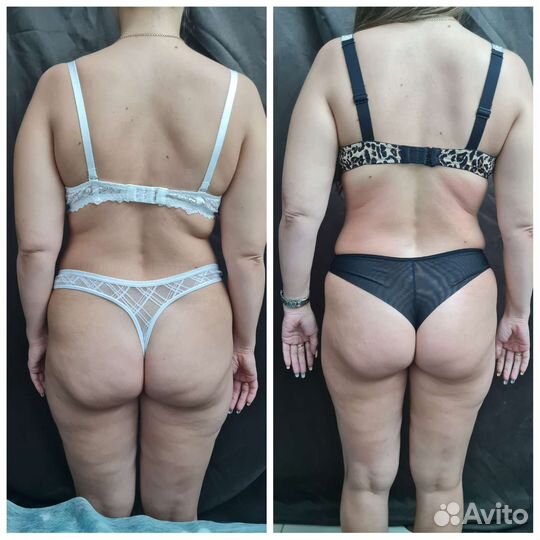 Ручной антицелюлитный массаж