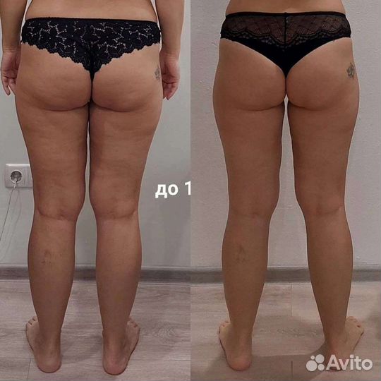 Криолиполиз, LPG, коррекция фигуры Светлогорск