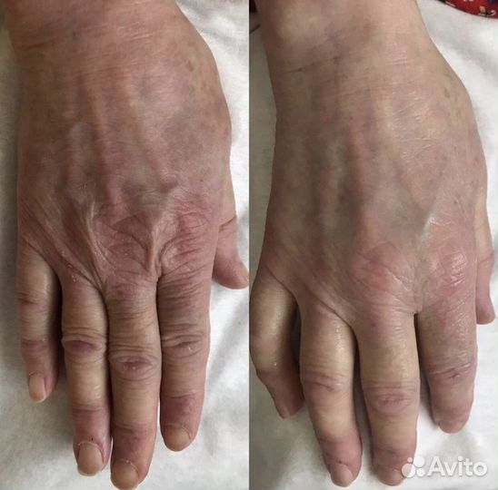 Лечение угревой сыпи