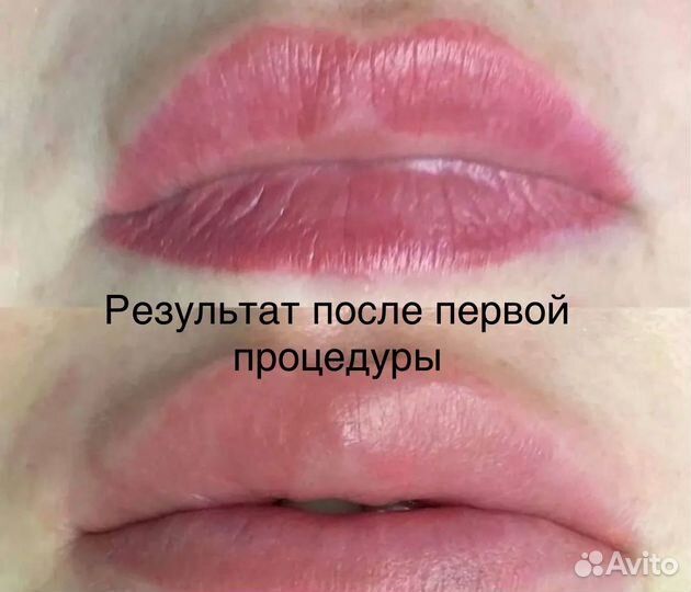 Лазерное удаление татуажа и тату в Москве