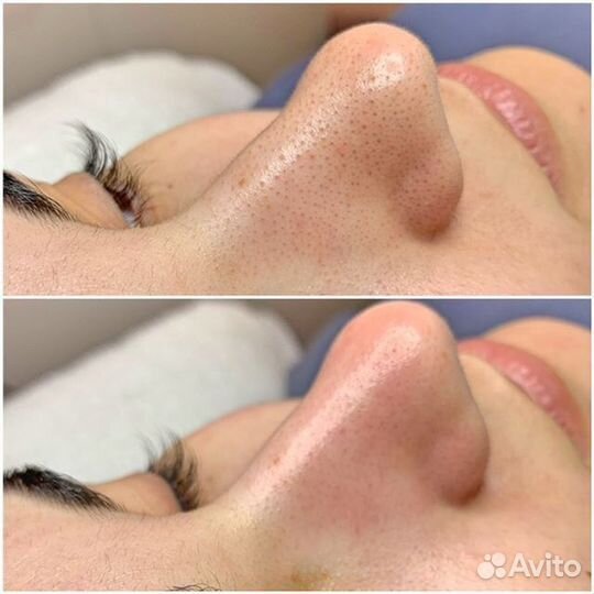 Чистка лица