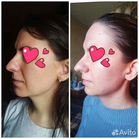 Скульптурно-буккальный массаж лица